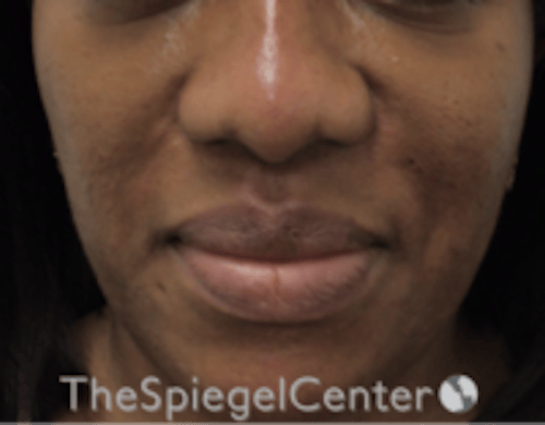 Nasolabial Fold Filler Before & After Gallery - Patient 603152 - Image 2