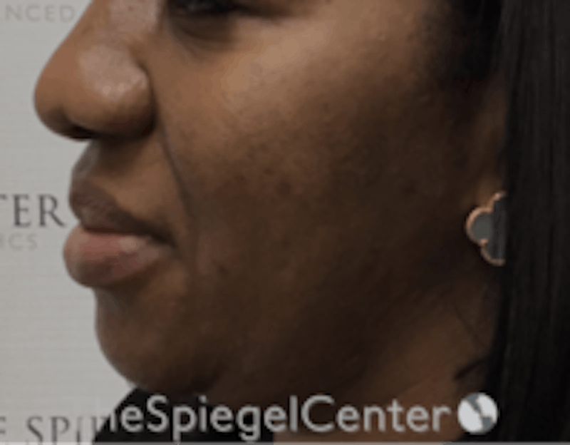 Nasolabial Fold Filler Before & After Gallery - Patient 603152 - Image 3