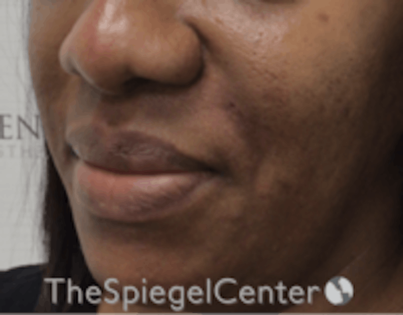 Nasolabial Fold Filler Before & After Gallery - Patient 603152 - Image 4