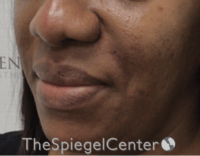 Nasolabial Fold Filler Before & After Gallery - Patient 603152 - Image 4