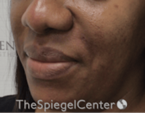 Nasolabial Fold Filler Before & After Gallery - Patient 603152 - Image 4