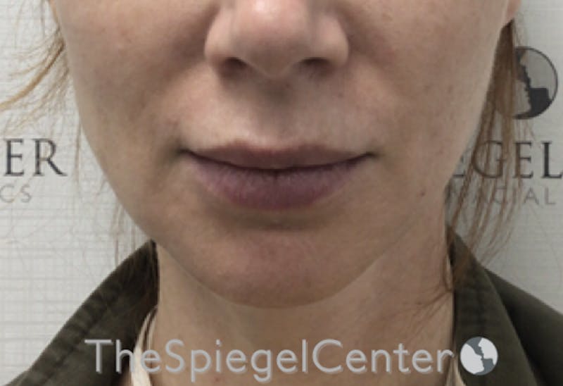 Nasolabial Fold Filler Before & After Gallery - Patient 324340 - Image 1
