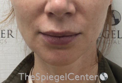 Nasolabial Fold Filler Before & After Gallery - Patient 324340 - Image 1