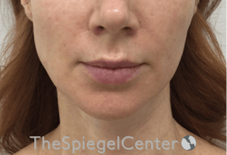 Nasolabial Fold Filler Before & After Gallery - Patient 324340 - Image 2