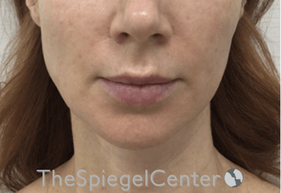 Nasolabial Fold Filler Before & After Gallery - Patient 324340 - Image 2