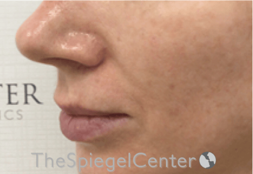 Nasolabial Fold Filler Before & After Gallery - Patient 324340 - Image 4