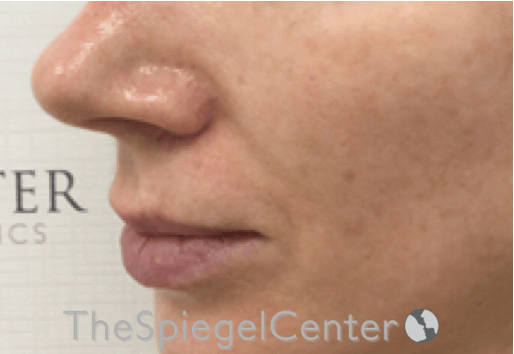 Nasolabial Fold Filler Before & After Gallery - Patient 324340 - Image 4