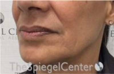 Nasolabial Fold Filler Before & After Gallery - Patient 145971 - Image 3