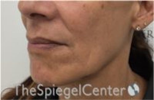 Nasolabial Fold Filler Before & After Gallery - Patient 145971 - Image 4