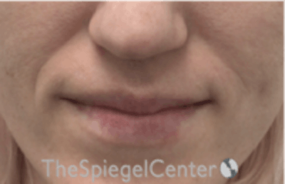 Nasolabial Fold Filler Before & After Gallery - Patient 256846 - Image 1