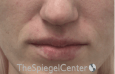 Nasolabial Fold Filler Before & After Gallery - Patient 256846 - Image 2