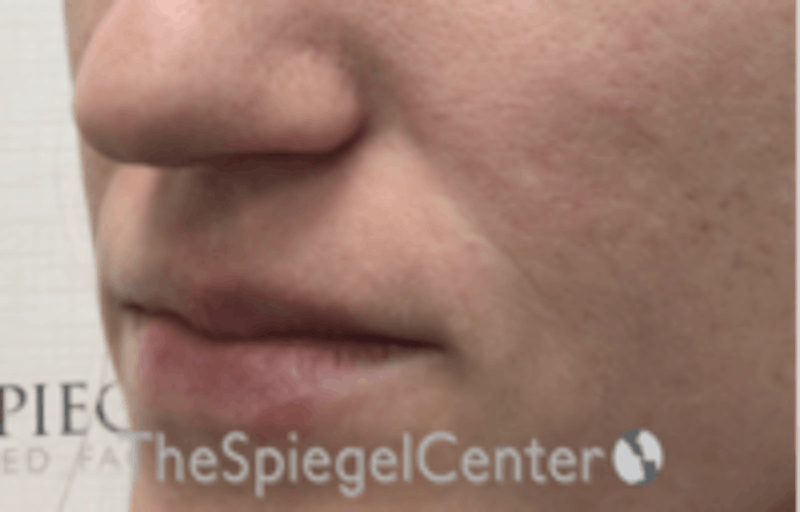 Nasolabial Fold Filler Before & After Gallery - Patient 256846 - Image 3