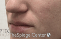Nasolabial Fold Filler Before & After Gallery - Patient 256846 - Image 3