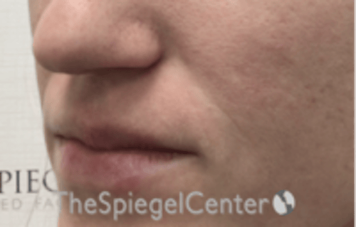 Nasolabial Fold Filler Before & After Gallery - Patient 256846 - Image 3