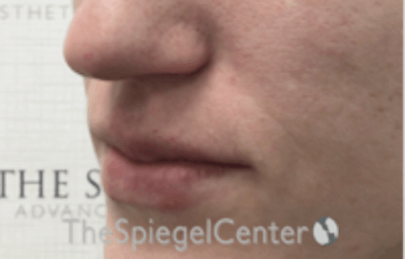 Nasolabial Fold Filler Before & After Gallery - Patient 256846 - Image 4