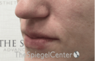 Nasolabial Fold Filler Before & After Gallery - Patient 256846 - Image 4