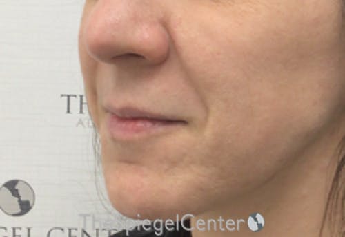 Nasolabial Fold Filler Before & After Gallery - Patient 236085 - Image 3