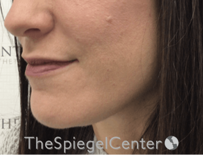 Nasolabial Fold Filler Before & After Gallery - Patient 316951 - Image 1