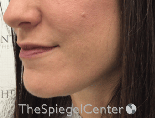 Nasolabial Fold Filler Before & After Gallery - Patient 316951 - Image 1