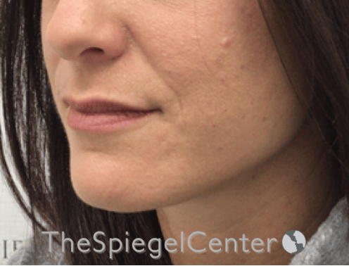 Nasolabial Fold Filler Before & After Gallery - Patient 316951 - Image 2