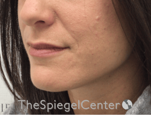 Nasolabial Fold Filler Before & After Gallery - Patient 316951 - Image 2