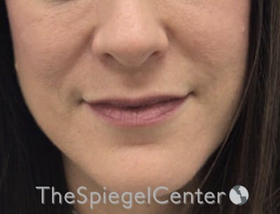 Nasolabial Fold Filler Before & After Gallery - Patient 316951 - Image 3