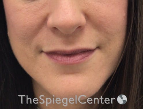 Nasolabial Fold Filler Before & After Gallery - Patient 316951 - Image 3