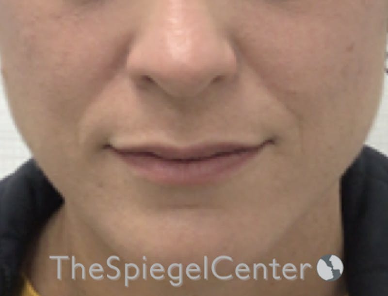 Nasolabial Fold Filler Before & After Gallery - Patient 316951 - Image 4