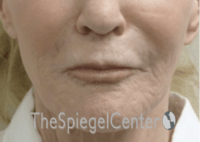 Nasolabial Fold Filler Before & After Gallery - Patient 826475 - Image 1