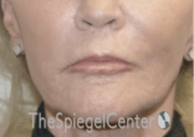 Nasolabial Fold Filler Before & After Gallery - Patient 826475 - Image 2