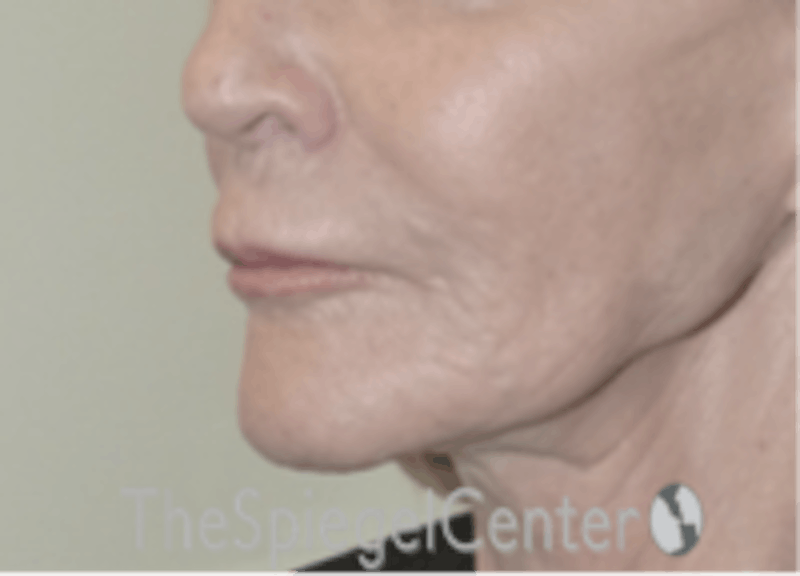 Nasolabial Fold Filler Before & After Gallery - Patient 826475 - Image 3