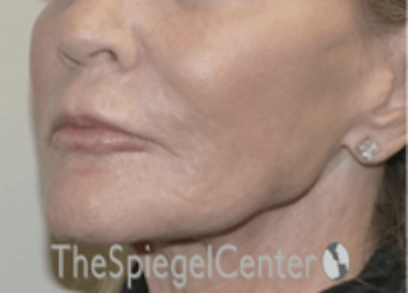 Nasolabial Fold Filler Before & After Gallery - Patient 826475 - Image 4