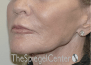 Nasolabial Fold Filler Before & After Gallery - Patient 826475 - Image 4