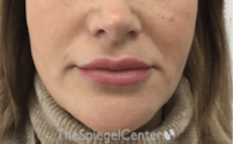 Nasolabial Fold Filler Before & After Gallery - Patient 266628 - Image 1