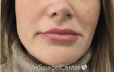 Nasolabial Fold Filler Before & After Gallery - Patient 266628 - Image 2