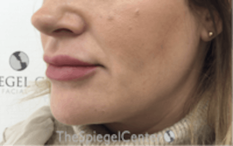 Nasolabial Fold Filler Before & After Gallery - Patient 266628 - Image 3
