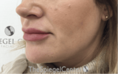Nasolabial Fold Filler Before & After Gallery - Patient 266628 - Image 3