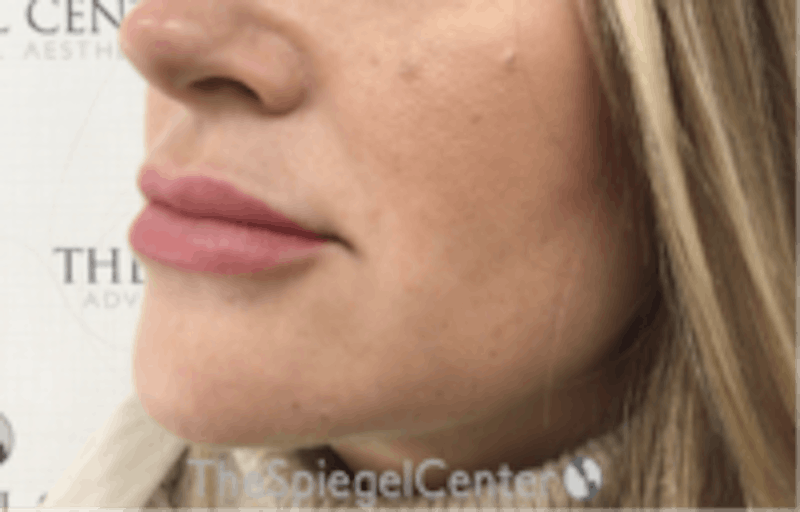 Nasolabial Fold Filler Before & After Gallery - Patient 266628 - Image 4