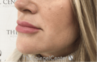 Nasolabial Fold Filler Before & After Gallery - Patient 266628 - Image 4