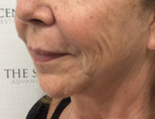 Nasolabial Fold Filler Before & After Gallery - Patient 209059 - Image 3