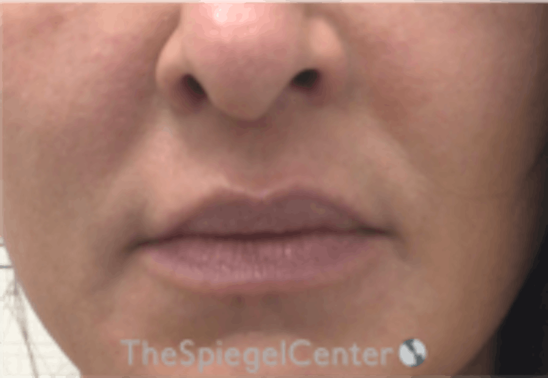 Nasolabial Fold Filler Before & After Gallery - Patient 305537 - Image 1