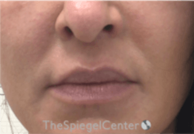Nasolabial Fold Filler Before & After Gallery - Patient 305537 - Image 1