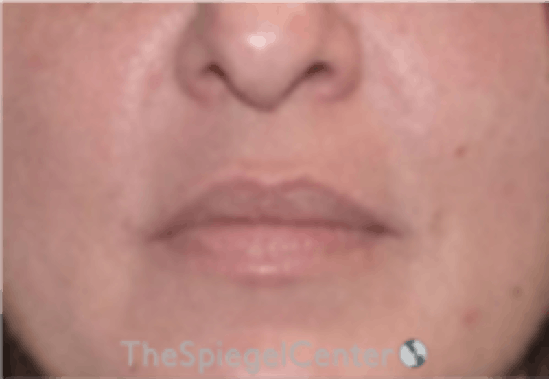 Nasolabial Fold Filler Before & After Gallery - Patient 305537 - Image 2