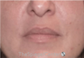 Nasolabial Fold Filler Before & After Gallery - Patient 305537 - Image 2