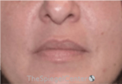 Nasolabial Fold Filler Before & After Gallery - Patient 305537 - Image 2
