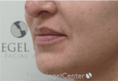 Nasolabial Fold Filler Before & After Gallery - Patient 305537 - Image 3