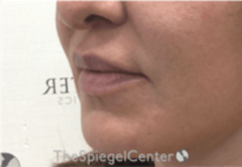 Nasolabial Fold Filler Before & After Gallery - Patient 305537 - Image 4
