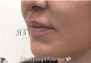 Nasolabial Fold Filler Before & After Gallery - Patient 305537 - Image 4
