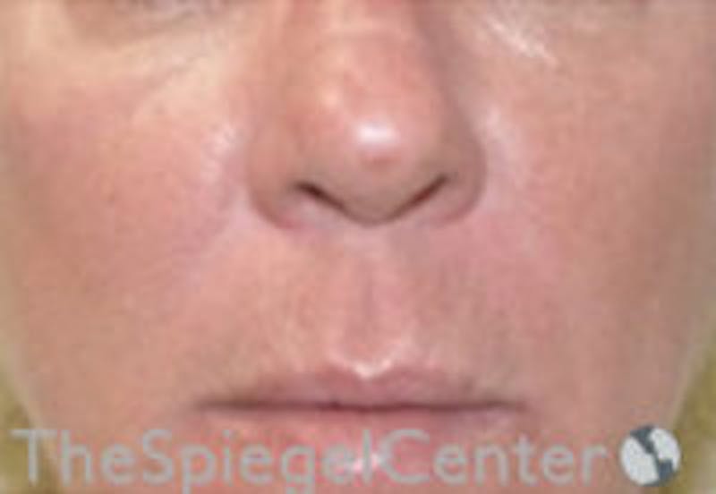 Nasolabial Fold Filler Before & After Gallery - Patient 308341 - Image 2