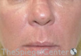 Nasolabial Fold Filler Before & After Gallery - Patient 308341 - Image 2